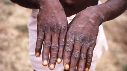 BSMMU says no monkeypox case detected, warns of rumours