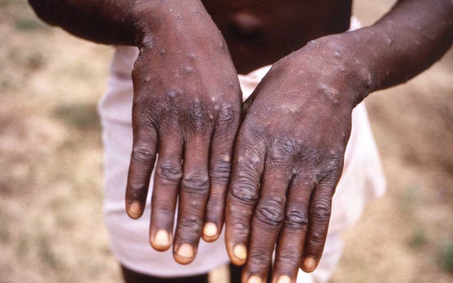 BSMMU says no monkeypox case detected, warns of rumours