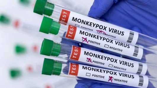 First case of monkeypox confirmed in Ireland