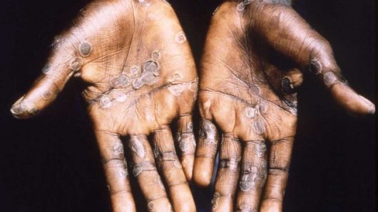 WHO calls emergency meeting as monkeypox cases cross 100 in Europe