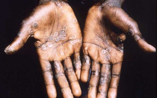 WHO calls emergency meeting as monkeypox cases cross 100 in Europe