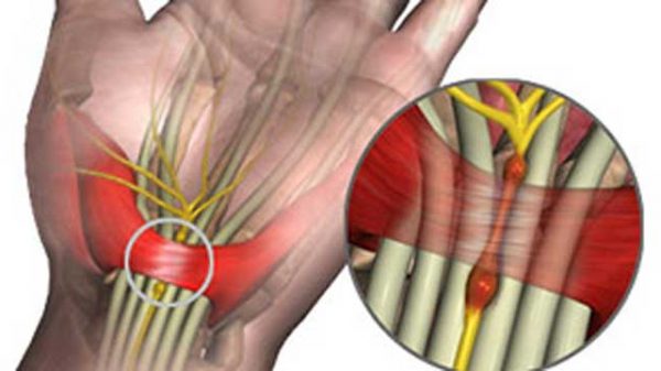 কারপাল টানেল সিন্ড্রোম : কারণ, লক্ষণ ও চিকিৎসা